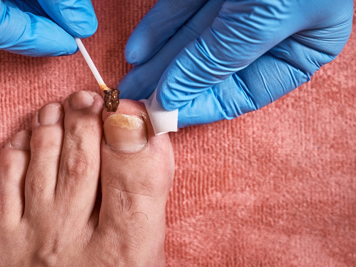 A medicinal ointment is applied to the nail affected by the fungus