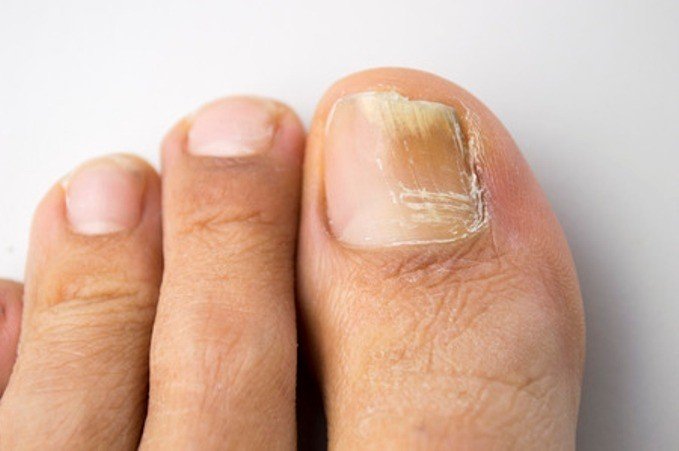toenail-fungus