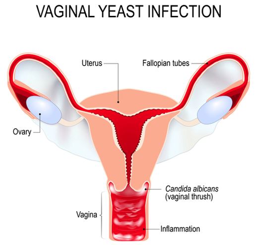 A poster showing different aspects of a vaginal yeast infection (candida)
