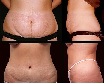 Do You Require Tummy Tucking or Liposuction?