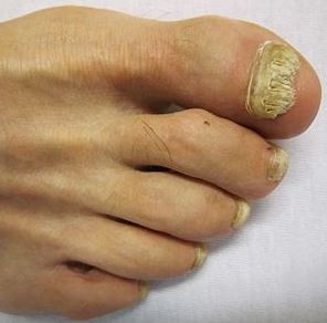 A toenail affected by nail fungus