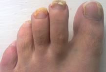 What Is Nail Fungus